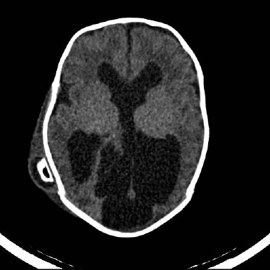 EMR062011 fig 2 Shunt failure.jpg