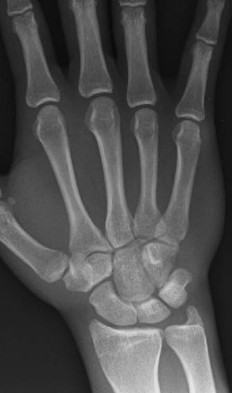 EMR 112111 fig 2 normal wrist PA.jpg