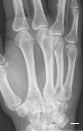 EMR 112111 fig 4 triquetral fracture.jpg