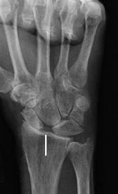 EMR 112111 fig 5 scapholunate dislocation.jpg