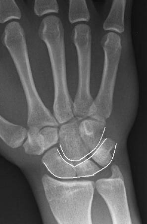 EMR 112111 fig 6 lines of carpal bones.jpg