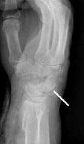 EMR 112111 fig 9 perilunate dislocation.jpg