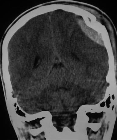 Figure 1 - Epidural Hematoma.jpg