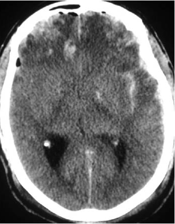 Figure 3 - Subarachnoid Hemorrhage.jpg