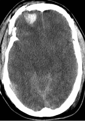 Figure 4 - Intracerebral Contusion.jpg