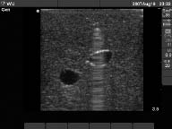 Figure 6 Ring down from needle over vein.tif