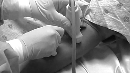 Figure 8 Ultrasound Picture PIV Access Short Axis.jpg