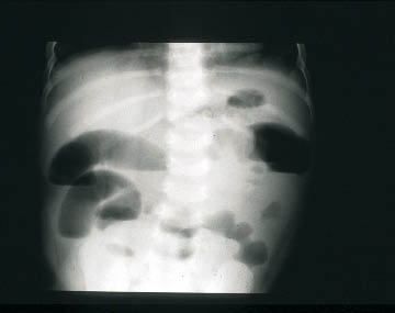 INTUSSUSCEPTION.png