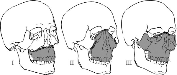LeFort fractures.jpeg
