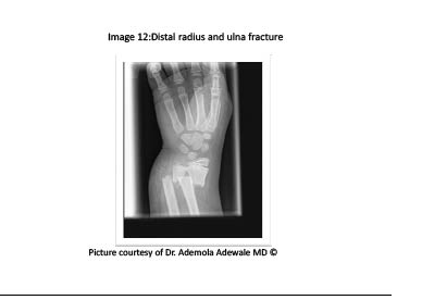PDMR0711 figure 13 distal radius and ulna fracture.pdf