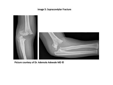 PDMR0711 figure 7 supracondylar fracture.pdf