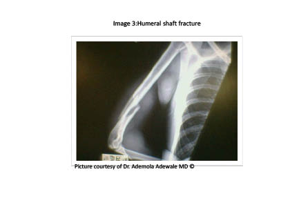 PDMR 0711 figure 5 humeral shaft fracture.pdf
