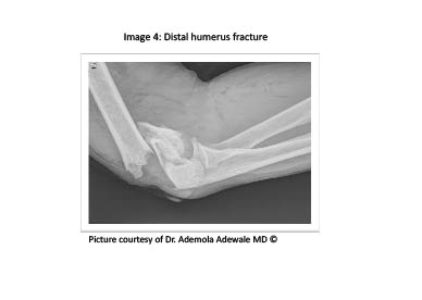 PDMR 0711 figure 6 distal humerus fracture.pdf