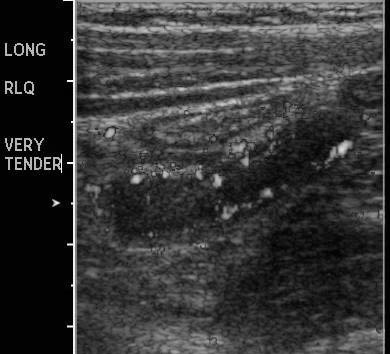 PDMR 1011 appendicitis ultrasound BW_0001.jpg