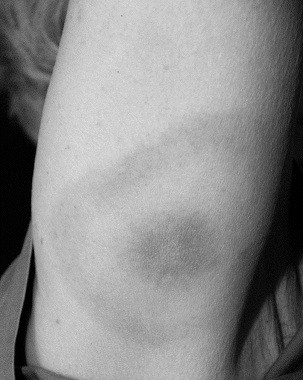 PDMR 1211lyme disease rash_0001.jpg