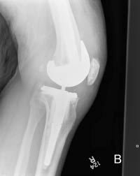 TR0701fig 3 b anterior prosthetic dislocation.pdf
