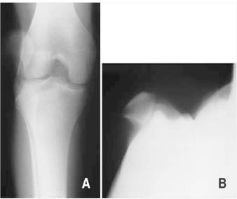 TR0701fig 4 patellar dislocation.pdf