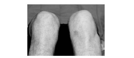 TR0701fig 5 tibiofibular joint dislocation_0001.jpg