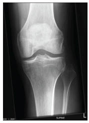 TR0701fig 6 lateral diplacement of fibular head.pdf