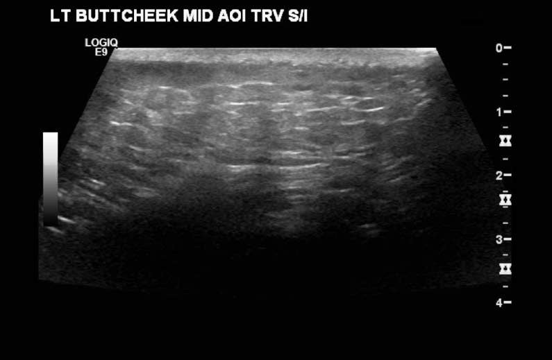 cellulitisopt.jpg