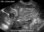 ectopic pregnancy.jpg