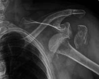 EMR elderly trauma FOOSH injuries.pdf