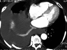 EMR elderly trauma hemothorax.pdf