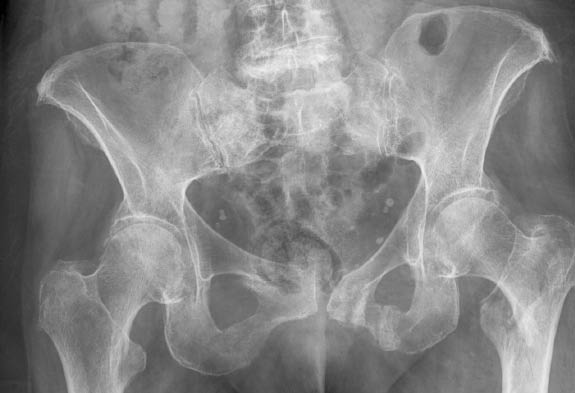EMR elderly trauma intertrochanteric fracture.pdf