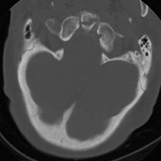 EMR elderly trauma odontoid fracture.pdf