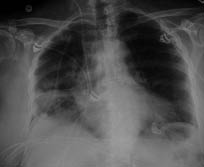 EMR elderly trauma rib fractures.pdf