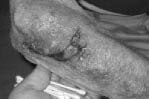 EMR elderly trauma skin tear_0001.jpg