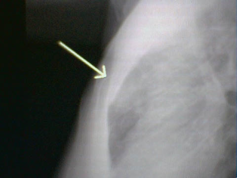 EMR elderly trauma sternal fracture and contusion.pdf