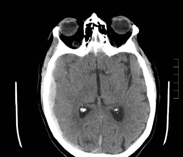 EMR elderly trauma subdural hematoma.pdf