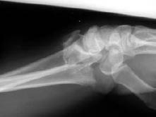EMR elderly trauma ulnar styloid fracture.pdf