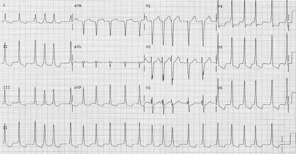 Afib in WPW rate 131 cropped.jpg