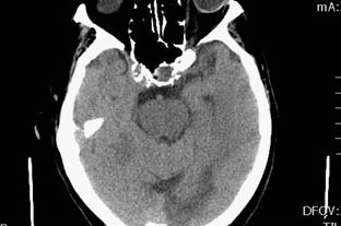 neurologic fig5 PCA infarct.pdf