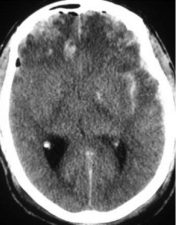 EMR 042312 Subarachnoid Hemorrhage.jpg