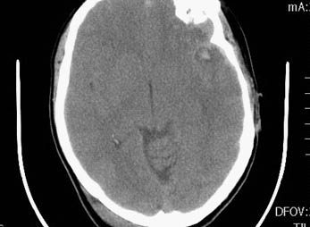 neurologic fig6 cerebral contusion.pdf