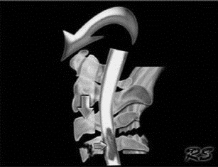 EMR061812 fig 14 flexion teardrop.jpg