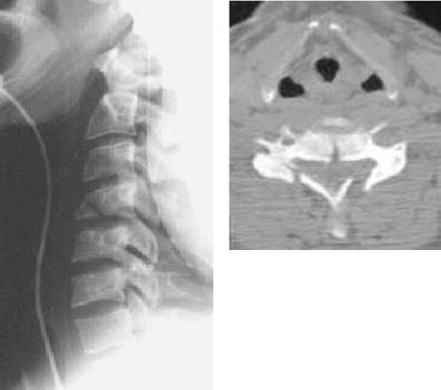 EMR061812 fig 15 flexion teardrop plain film and CT.pdf