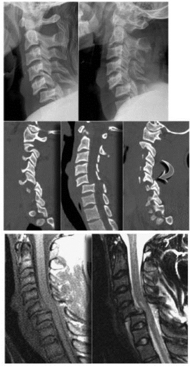 EMR061812 fig 19 bilateral facet dislocation.jpg
