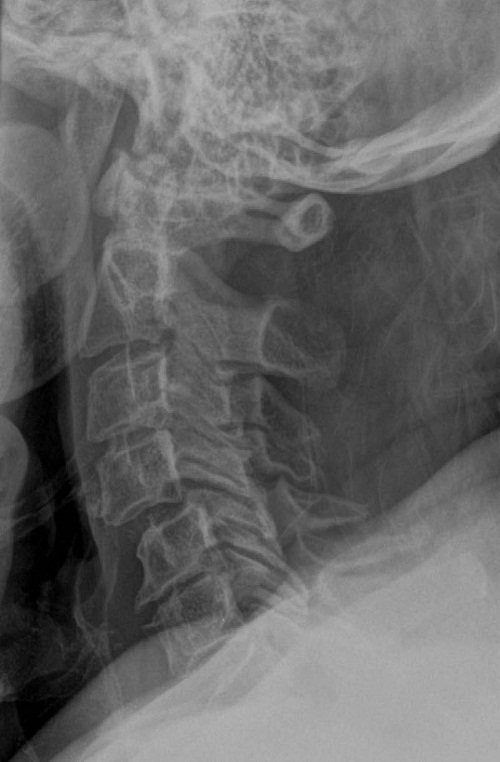 Figure 7 - C4-C5 Anterior Subluxation.jpg