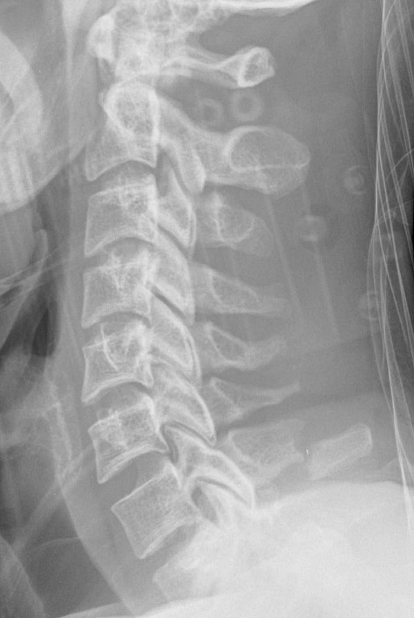 Figure 8 - C7 Spinous Process Fracture.jpg