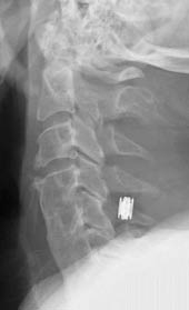 Figure 9a - Plain Radiograph.jpg