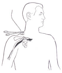 Figure 1. Foley catheter balloon tamponade of subclavian vessels. Demetriades.jpg