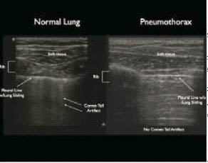 Figure 4. Comparison of normal lung and pneumothorax ACEP.jpg