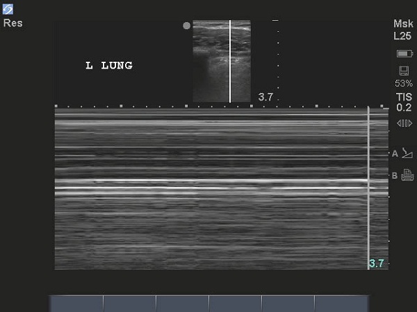 Figure 5b. M-mode pneumothorax Blankenship.png