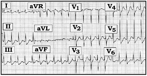 ECG Review 245- Grey.jpeg