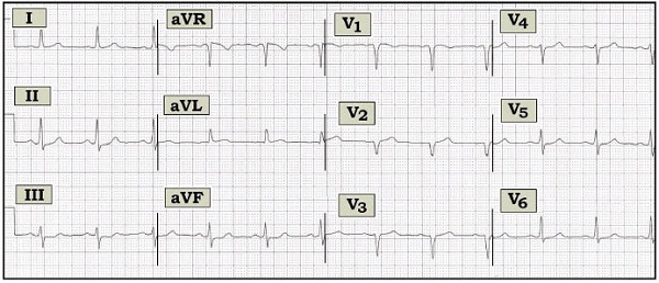 ECG Review 249-FIGURE-Grey.jpeg