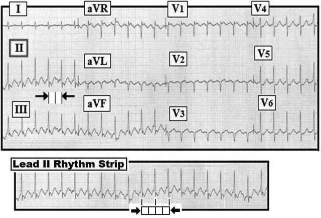 ECG Review 244-Reg SVT (grey).jpg
